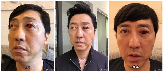 庾澄庆眼睛受伤 眼睛凸起布满红血丝画面吓人!