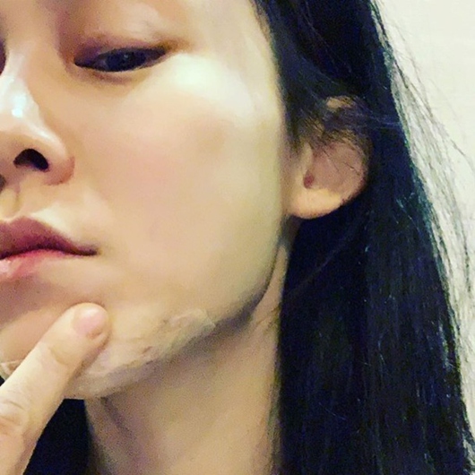 范玮琪下巴缝15针 皮肉外翻伤口很深