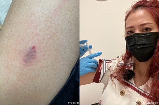 蔡少芬录节目时被狗咬伤 发文报平安已打狂犬疫苗