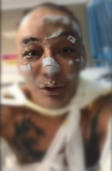 歌手徐真真全身二级深度烧伤 曾参加选秀节目《中国有嘻哈》